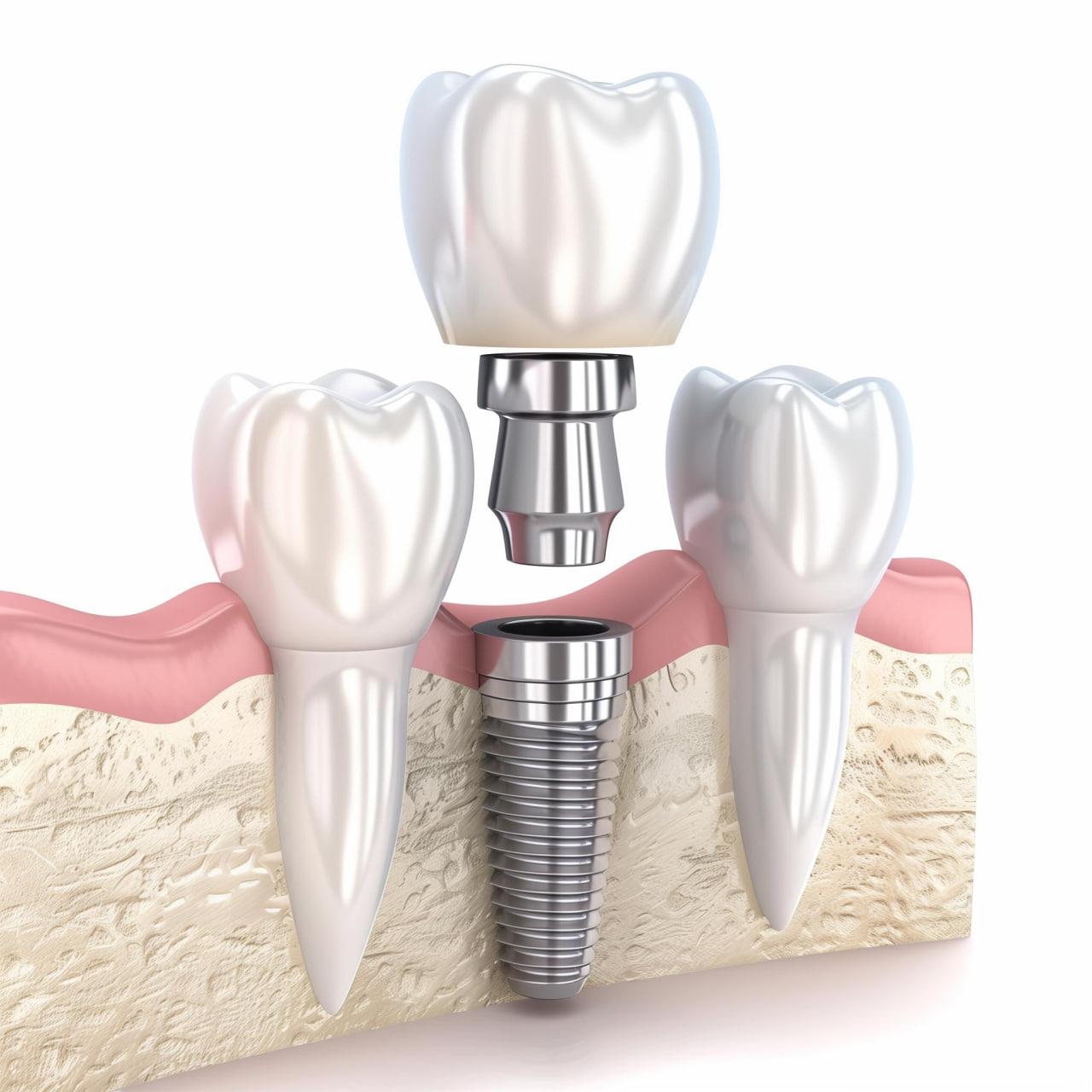Имплантация зубов в Сургуте